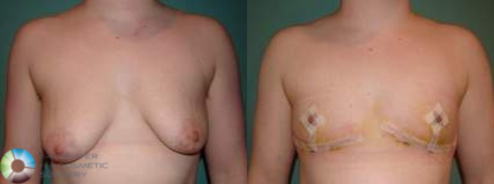 Before & After FTM Top Surgery/Chest Masculinization Case 561 Anterior in Denver and Colorado Springs, CO