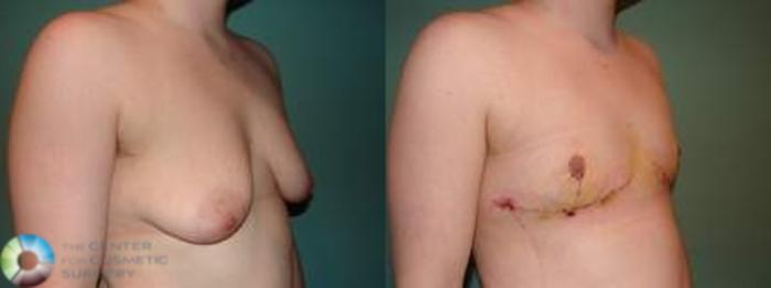 Before & After FTM Top Surgery/Chest Masculinization Case 561 Right Oblique View in Golden, CO