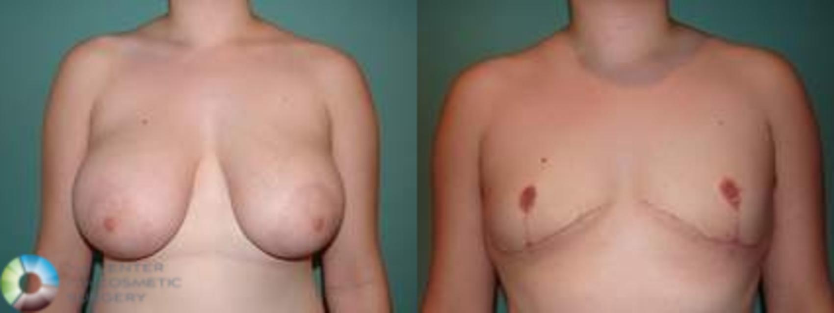 Before & After FTM Top Surgery/Chest Masculinization Case 562 Anterior in Denver and Colorado Springs, CO