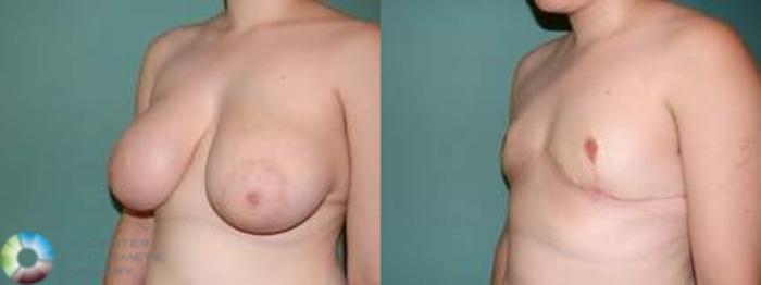 Before & After FTM Top Surgery/Chest Masculinization Case 562 Left Oblique in Denver and Colorado Springs, CO