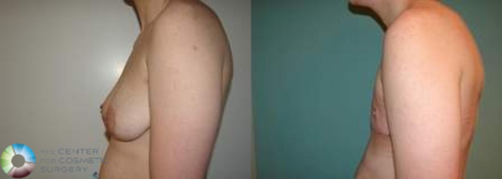 Before & After FTM Top Surgery/Chest Masculinization Case 564 Left Lateral in Denver and Colorado Springs, CO