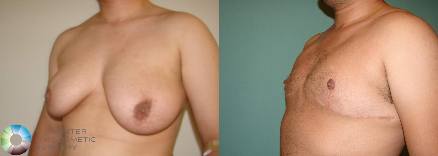Before & After FTM Top Surgery/Chest Masculinization Case 566 View #2 View in Golden, CO
