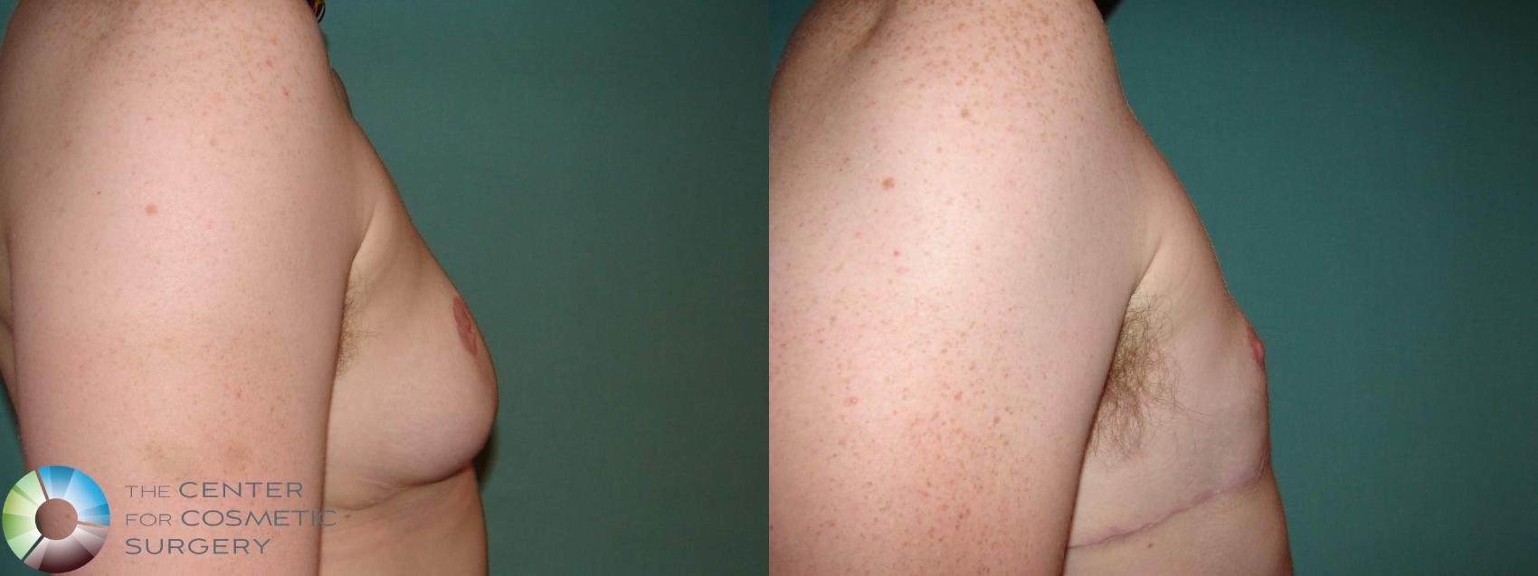 Before & After FTM Top Surgery/Chest Masculinization Case 609 Right Lateral in Denver and Colorado Springs, CO
