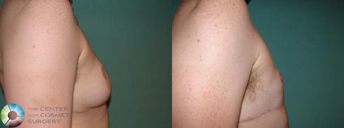 Before & After FTM Top Surgery/Chest Masculinization Case 609 Right Lateral View in Golden, CO