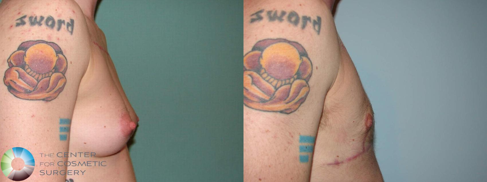 Before & After FTM Top Surgery/Chest Masculinization Case 610 Right Lateral in Denver and Colorado Springs, CO