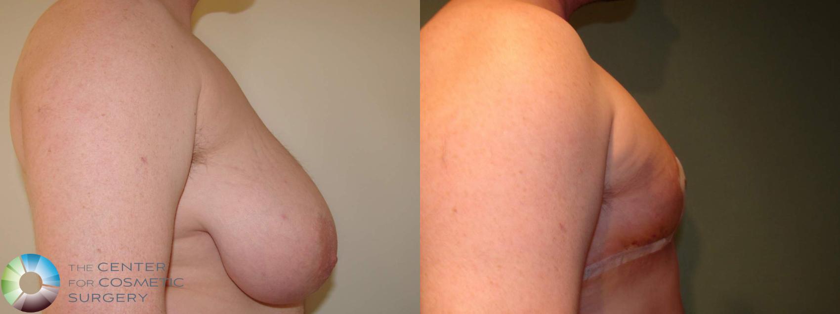 Before & After FTM Top Surgery/Chest Masculinization Case 611 Right Lateral in Denver and Colorado Springs, CO