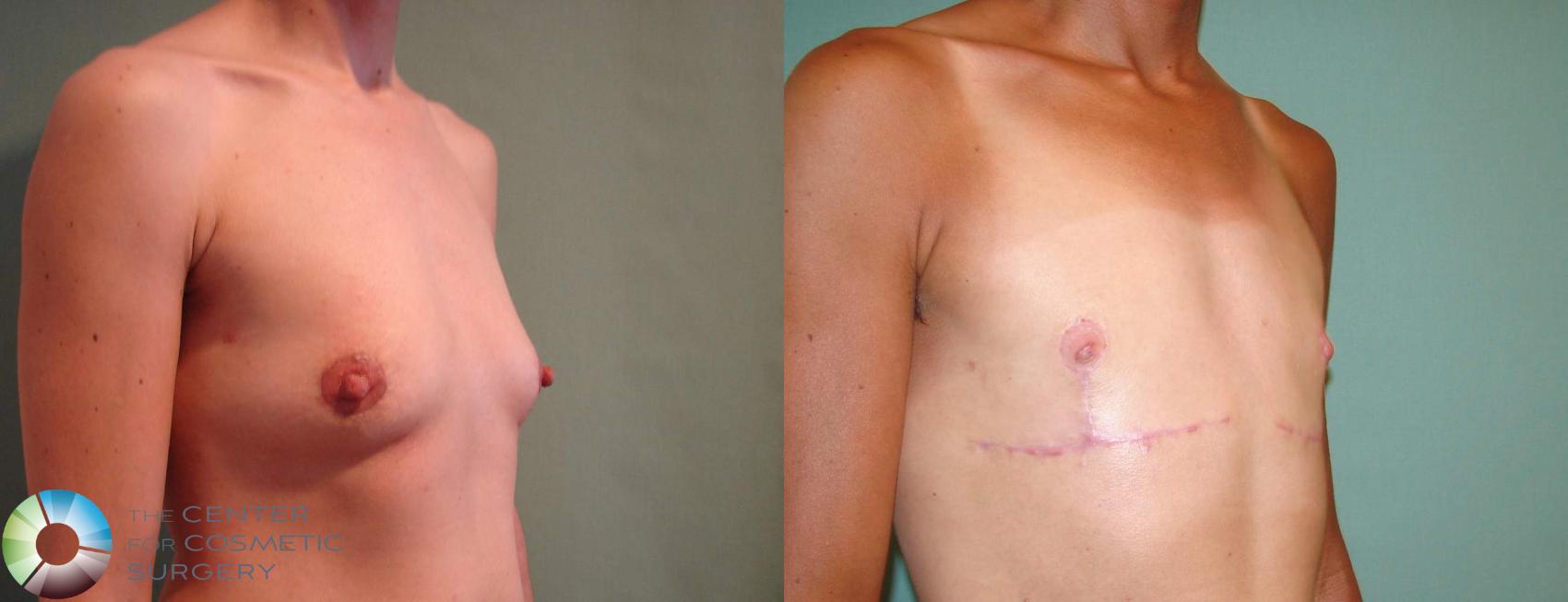 Before & After FTM Top Surgery/Chest Masculinization Case 642 View #1 in Denver and Colorado Springs, CO