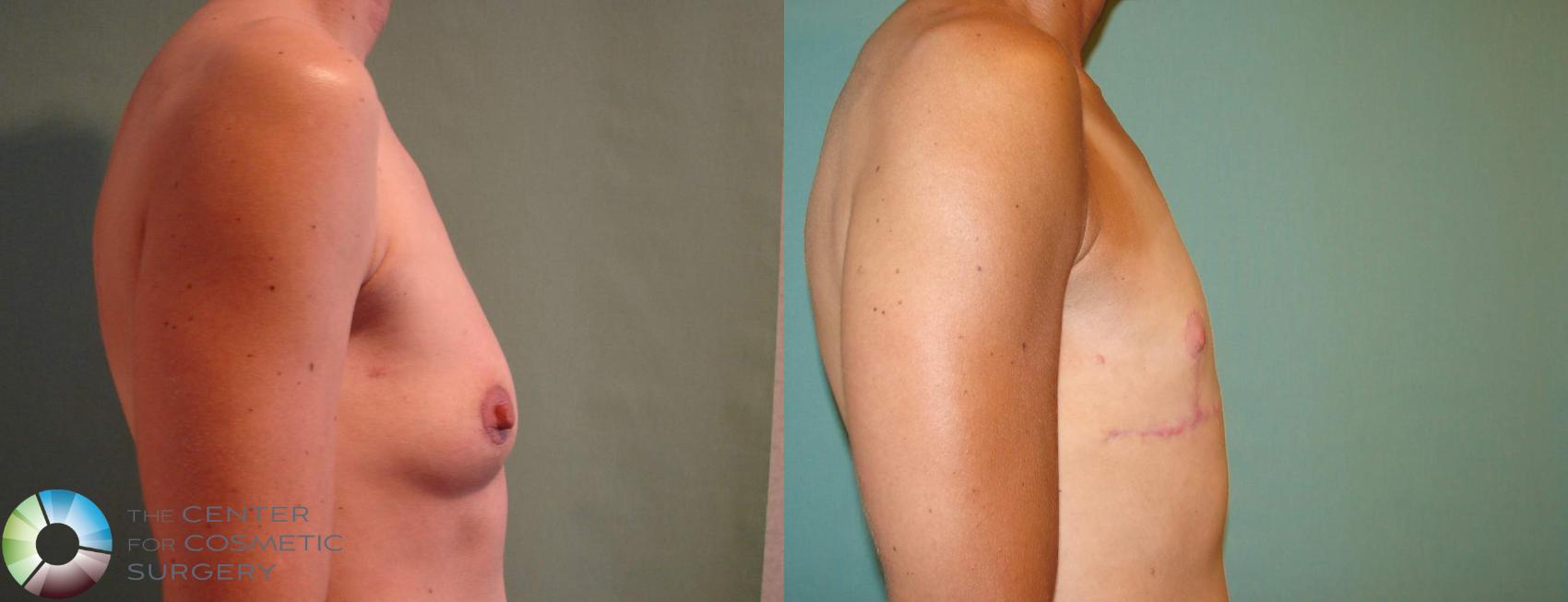 Before & After FTM Top Surgery/Chest Masculinization Case 642 View #2 in Denver and Colorado Springs, CO