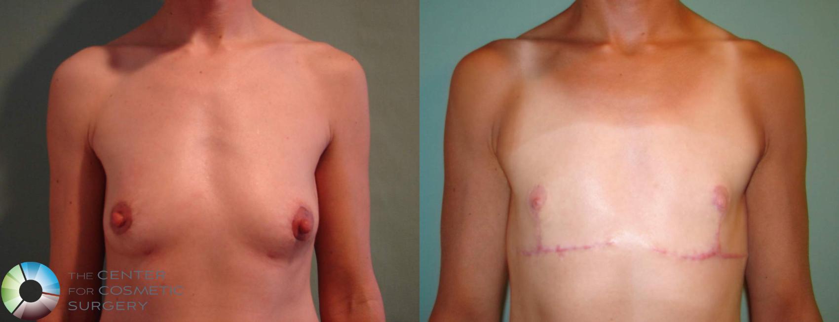 Before & After FTM Top Surgery/Chest Masculinization Case 642 View #3 in Denver and Colorado Springs, CO