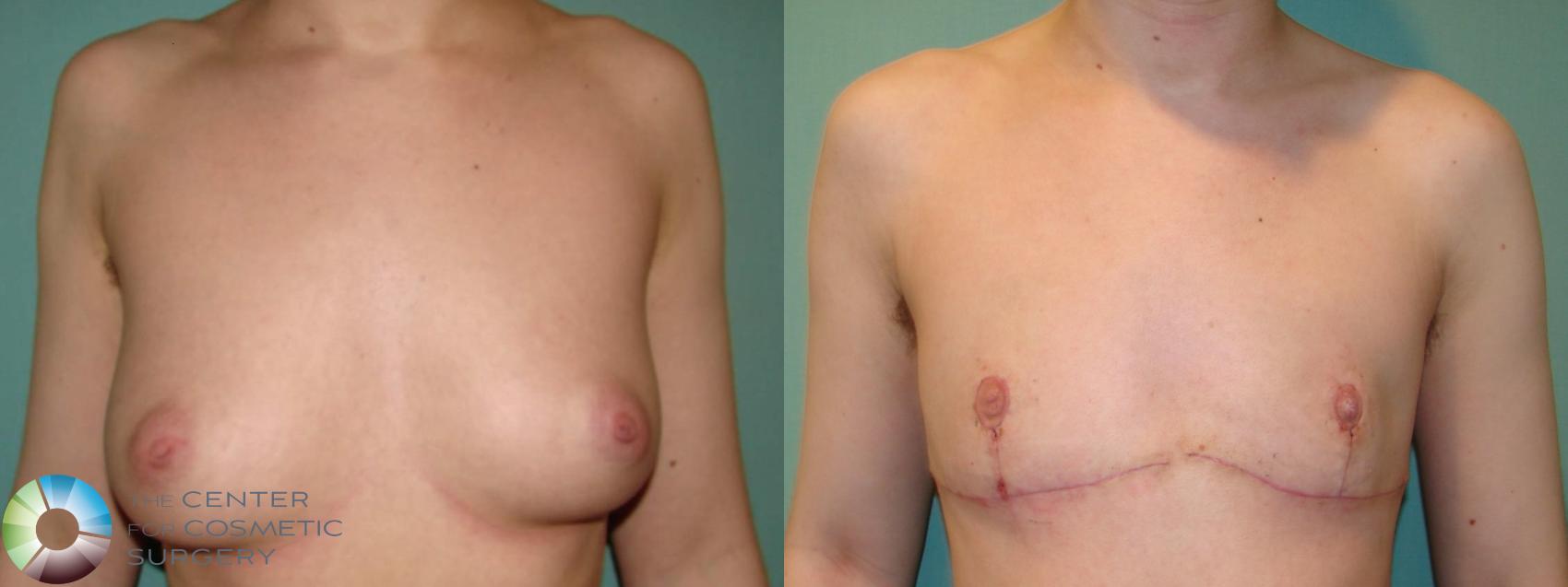 Before & After FTM Top Surgery/Chest Masculinization Case 643 Anterior View in Golden, CO