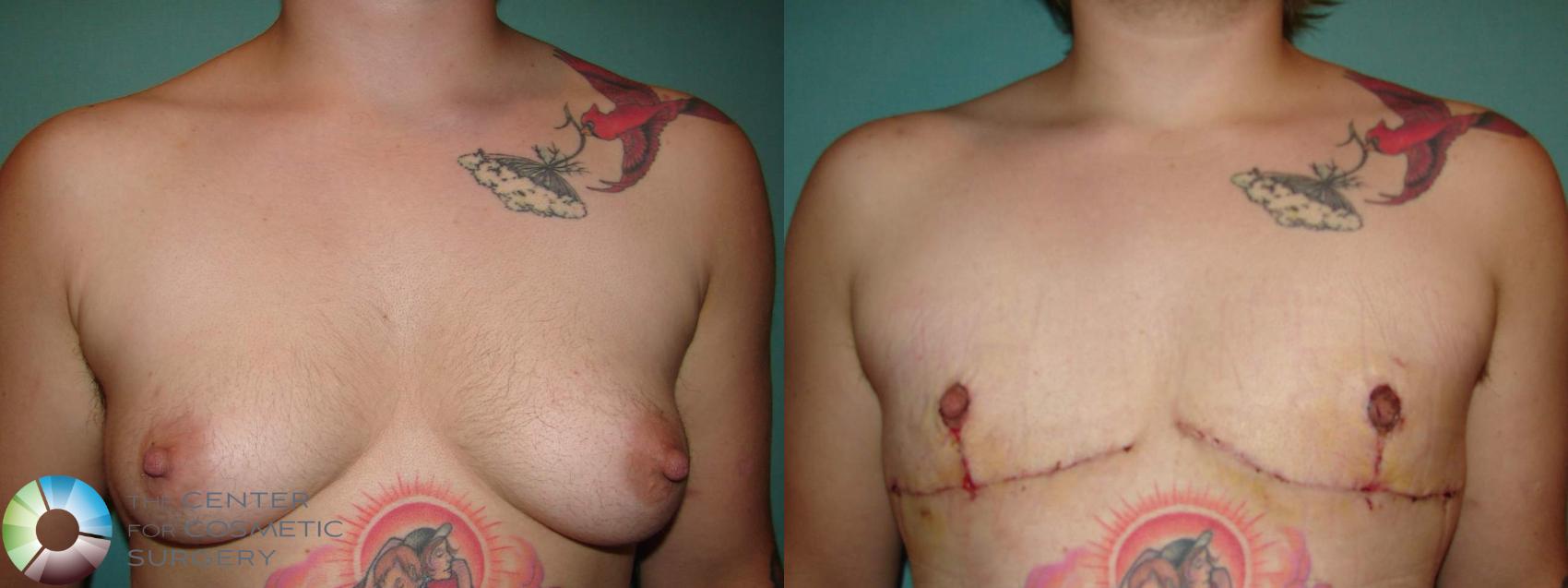 Before & After FTM Top Surgery/Chest Masculinization Case 649 Anterior in Denver and Colorado Springs, CO