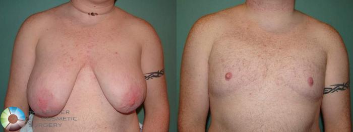 Before & After FTM Top Surgery/Chest Masculinization Case 663 Anterior View in Golden, CO