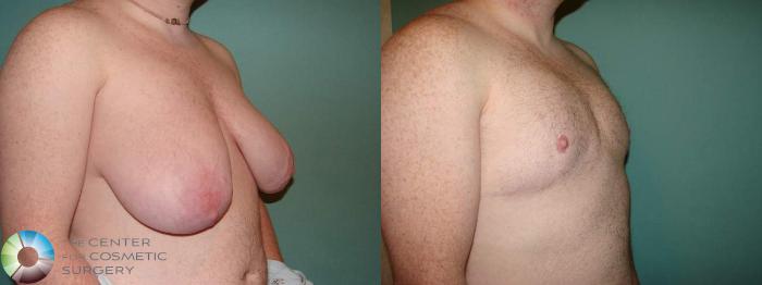 Before & After FTM Top Surgery/Chest Masculinization Case 663 Right Oblique View in Golden, CO