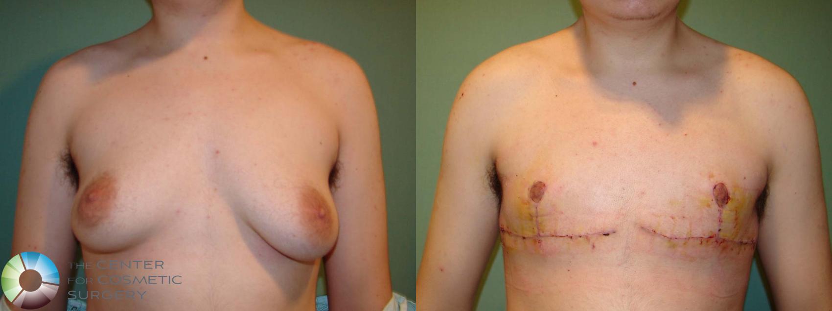 Before & After FTM Top Surgery/Chest Masculinization Case 671 Anterior View in Golden, CO