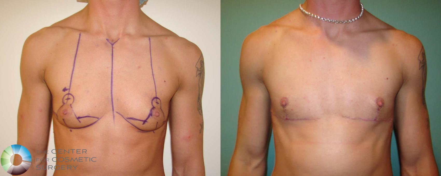 Before & After FTM Top Surgery/Chest Masculinization Case 672 View #1 in Denver and Colorado Springs, CO