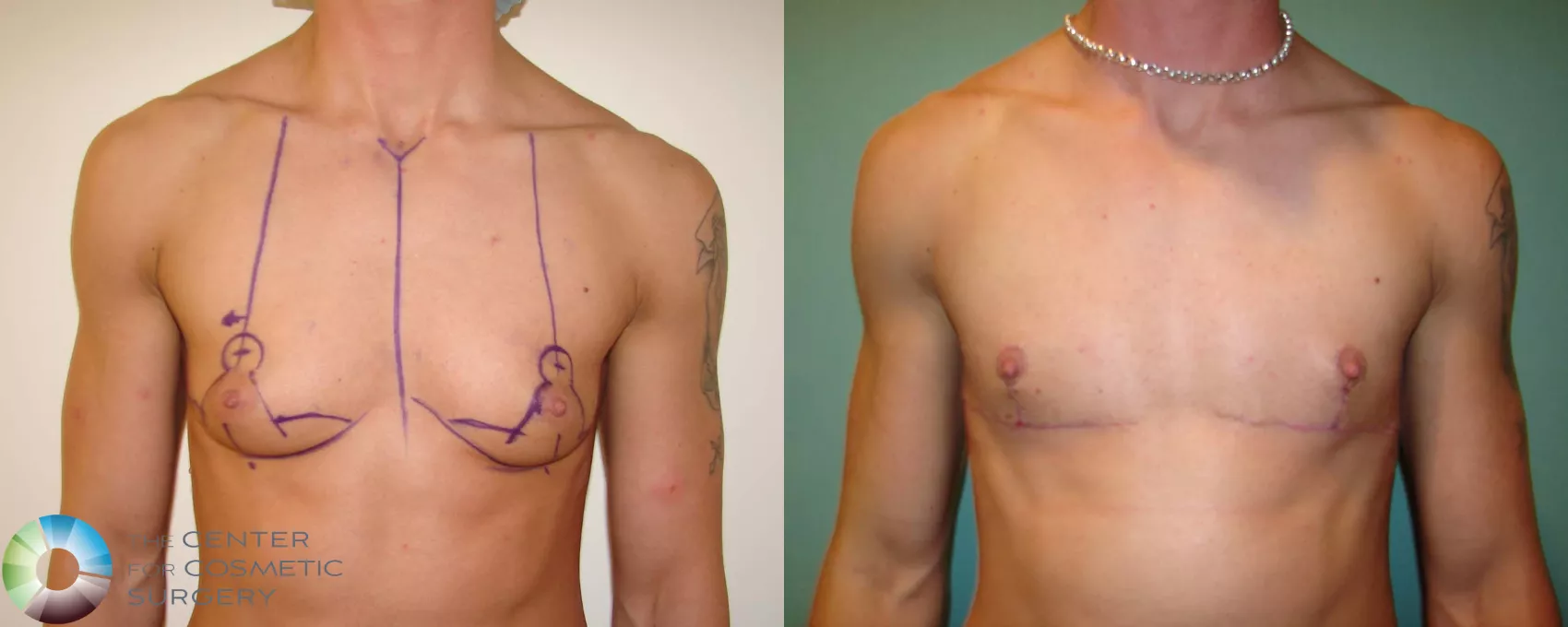 Ftm Top Surgery