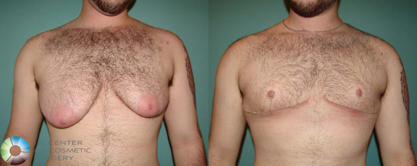 Before & After FTM Top Surgery/Chest Masculinization Case 674 View #1 in Denver and Colorado Springs, CO