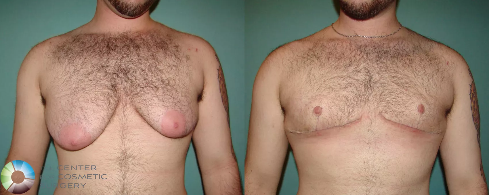 Chest Masculinization Before & Afters