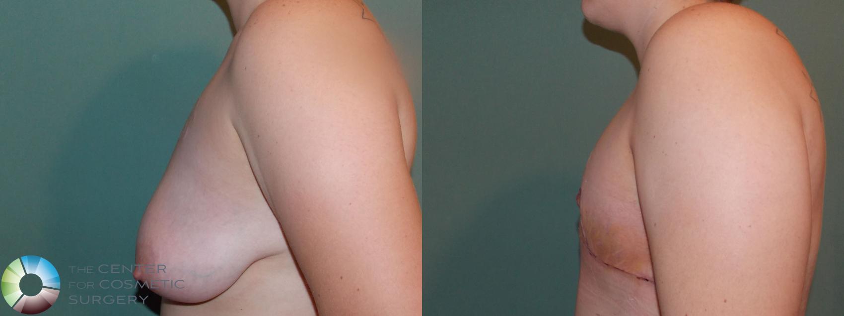 Before & After FTM Top Surgery/Chest Masculinization Case 697 Left Lateral in Denver and Colorado Springs, CO