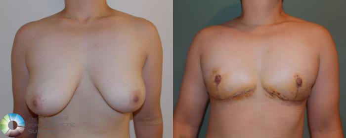 Before & After FTM Top Surgery/Chest Masculinization Case 700 View #1 View in Golden, CO