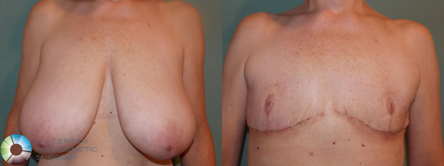 Best Denver Free-Nipple Graft/Double-Incision Top Surgery