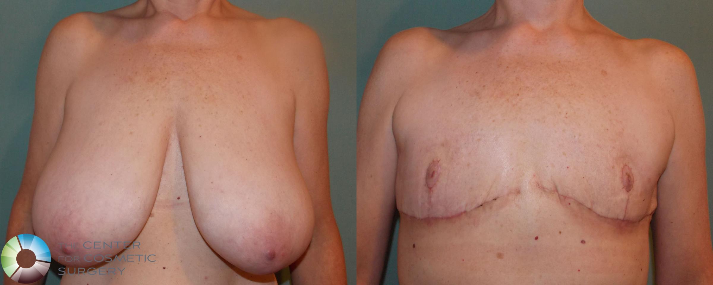 FTM Top Surgery/Chest Masculinization Case 701 Before & After View #1 | Golden, CO | The Center for Cosmetic Surgery