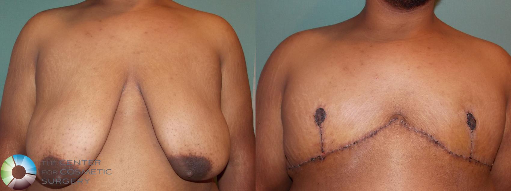 Before & After FTM Top Surgery/Chest Masculinization Case 702 Anterior in Denver and Colorado Springs, CO