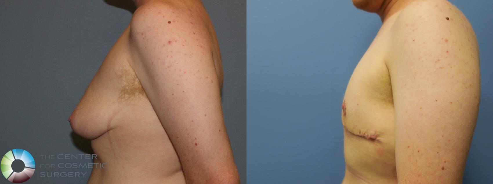 Before & After FTM Top Surgery/Chest Masculinization Case 766 Left lateral in Denver and Colorado Springs, CO