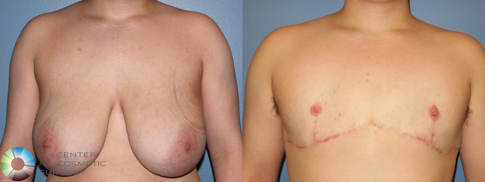 Before & After FTM Top Surgery/Chest Masculinization Case 856 View #1 in Denver and Colorado Springs, CO