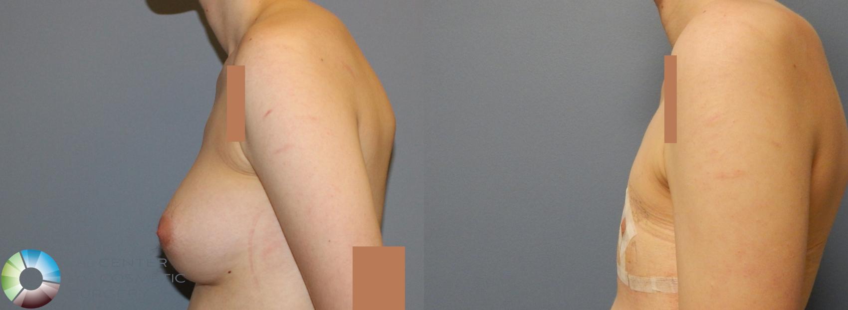 Before & After FTM Top Surgery/Chest Masculinization Case 857 View #3 View in Golden, CO