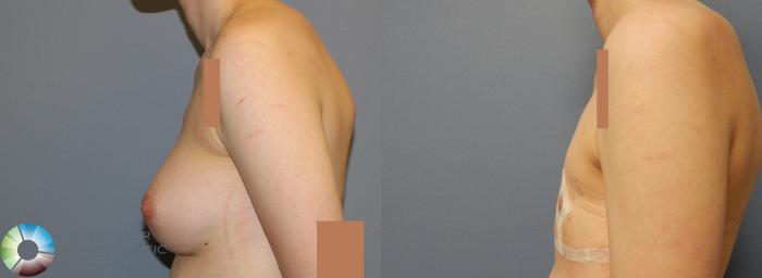 Before & After FTM Top Surgery/Chest Masculinization Case 857 View #3 in Denver and Colorado Springs, CO