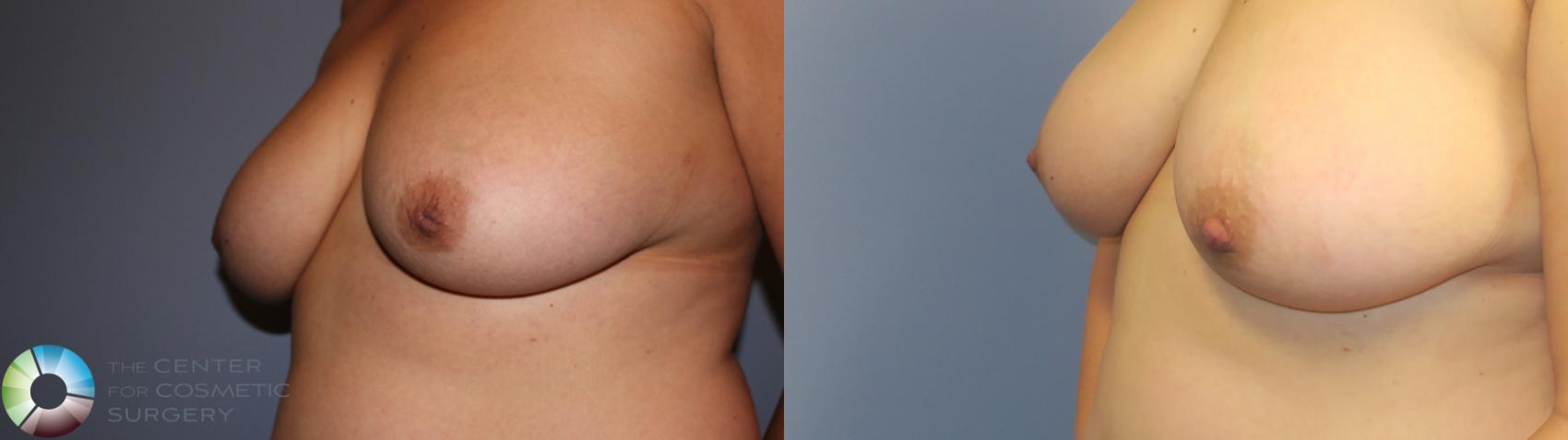 Before & After Inverted Nipple Repair Case 11338 Left Oblique View in Golden, CO