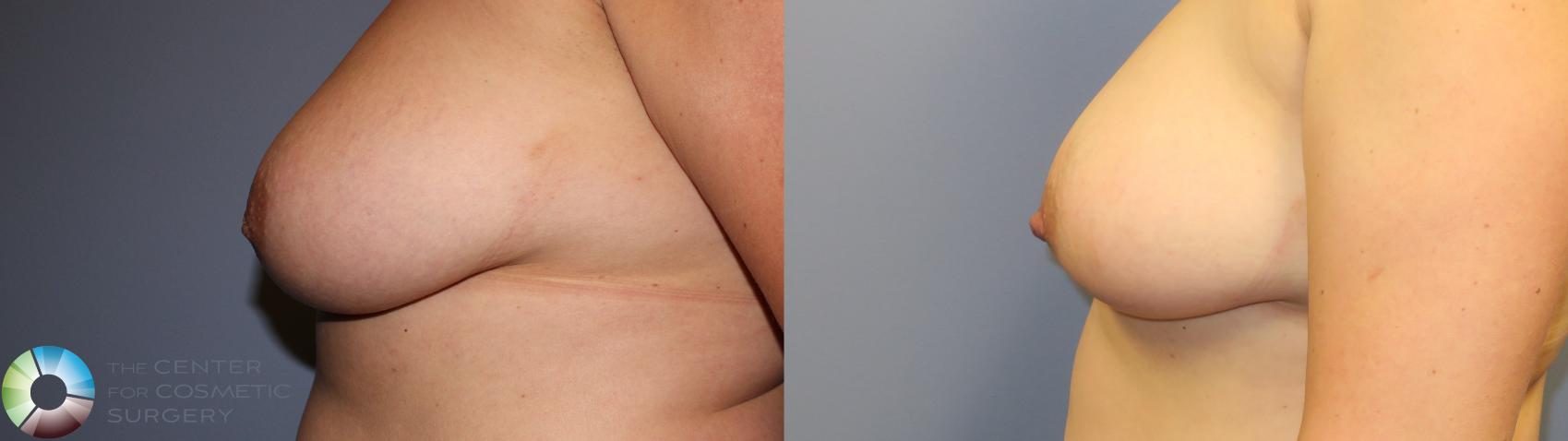 Before & After Inverted Nipple Repair Case 11338 Left Side in Denver and Colorado Springs, CO