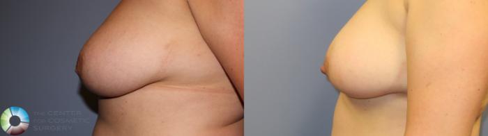 Before & After Inverted Nipple Repair Case 11338 Left Side View in Golden, CO