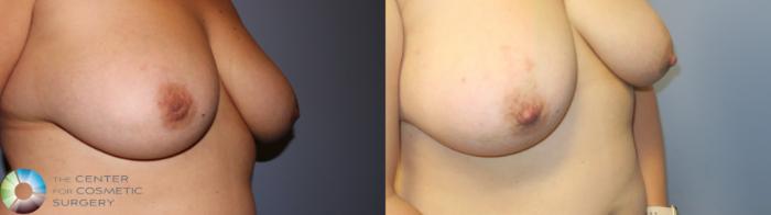 Before & After Inverted Nipple Repair Case 11338 Right Oblique View in Golden, CO
