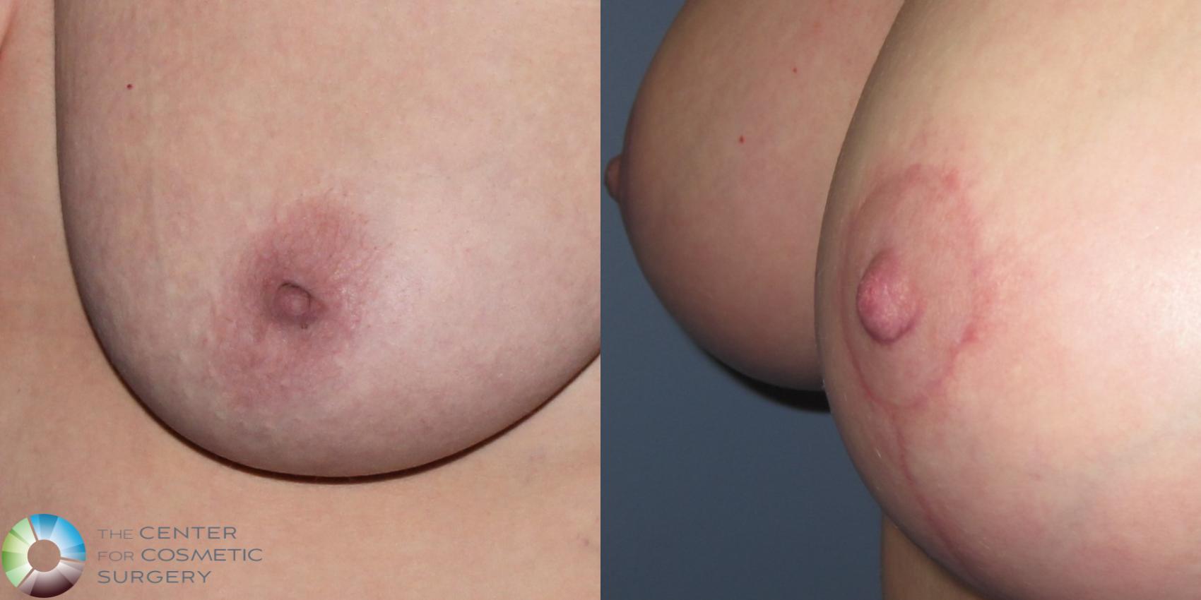 Before & After Inverted Nipple Repair Case 11339 Left Oblique View in Golden, CO