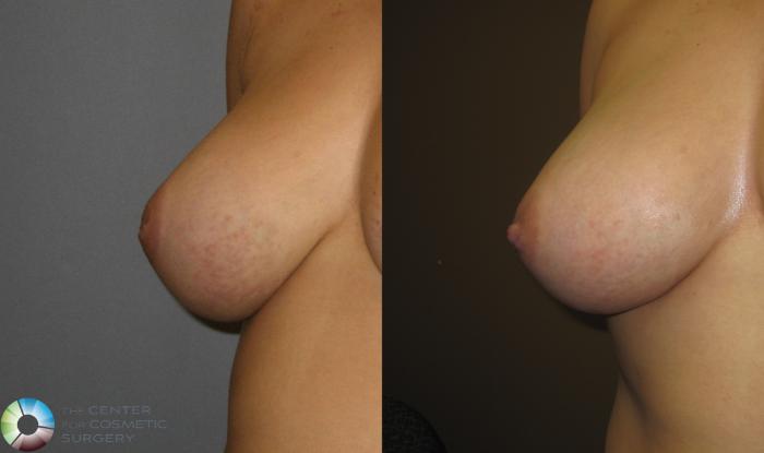 Before & After Inverted Nipple Repair Case 391 View #1 View in Golden, CO