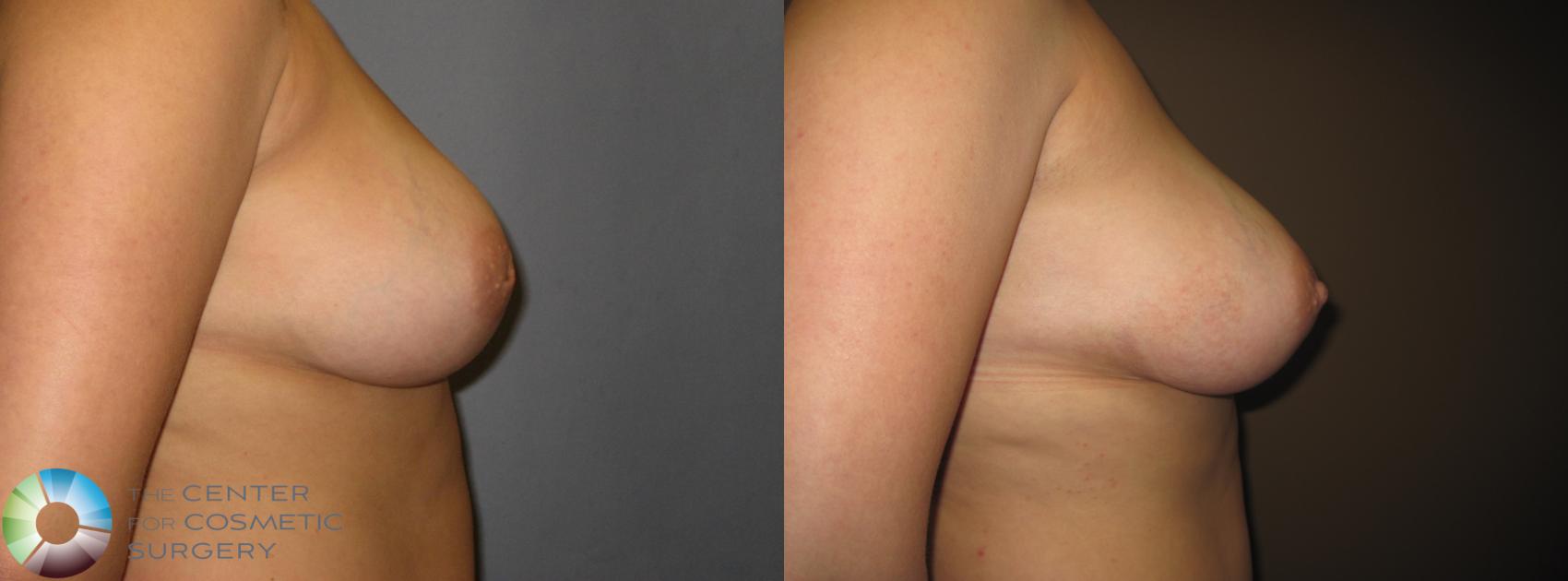 Before & After Inverted Nipple Repair Case 391 View #2 View in Golden, CO