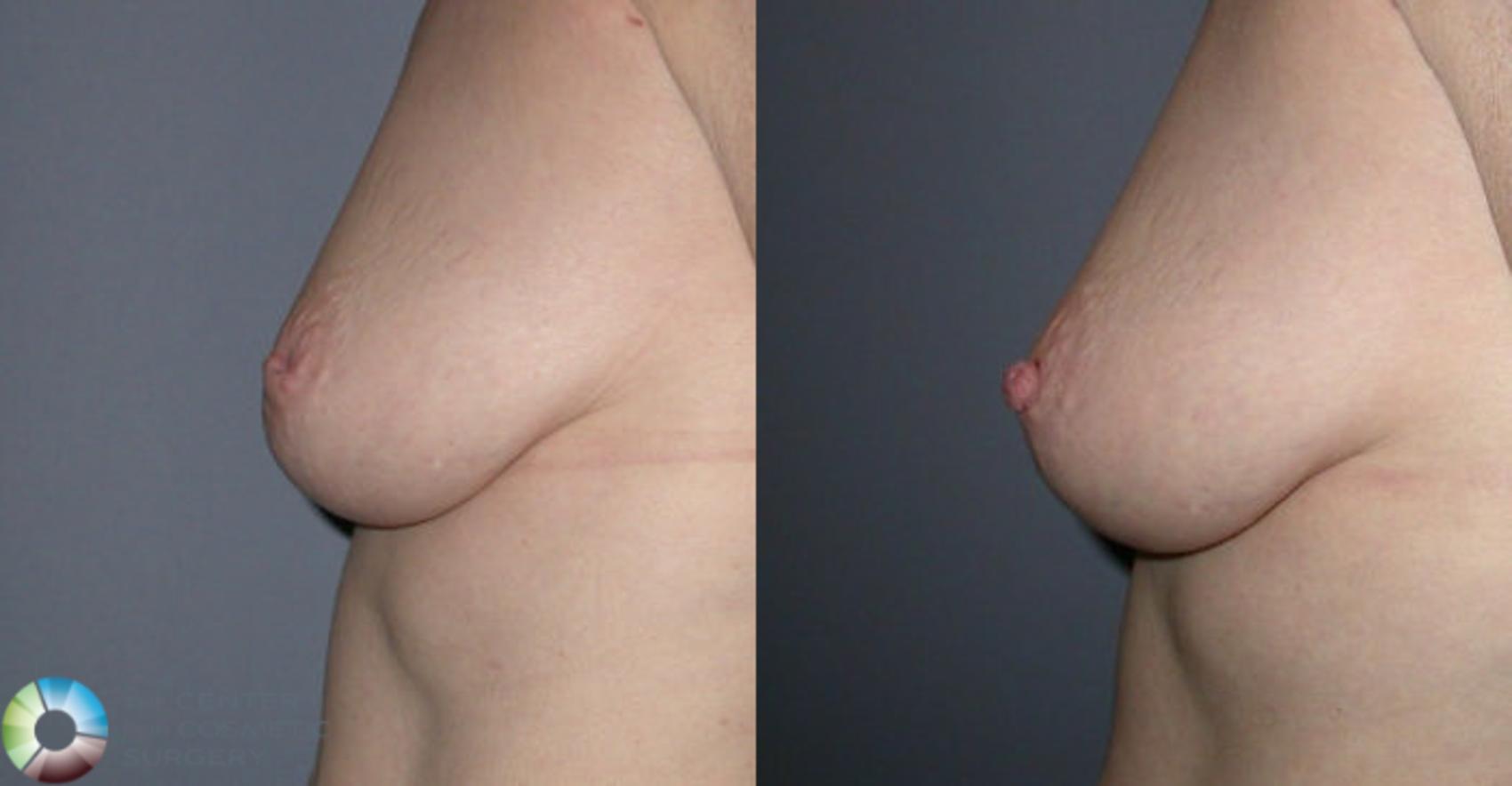 Before & After Inverted Nipple Repair Case 58 View #2 in Denver and Colorado Springs, CO