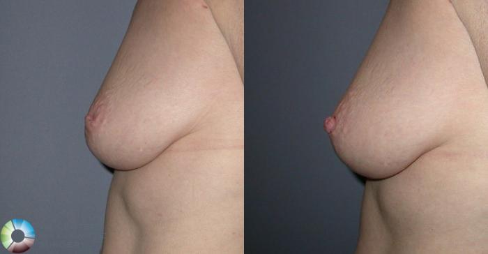 Before & After Inverted Nipple Repair Case 58 View #2 View in Golden, CO