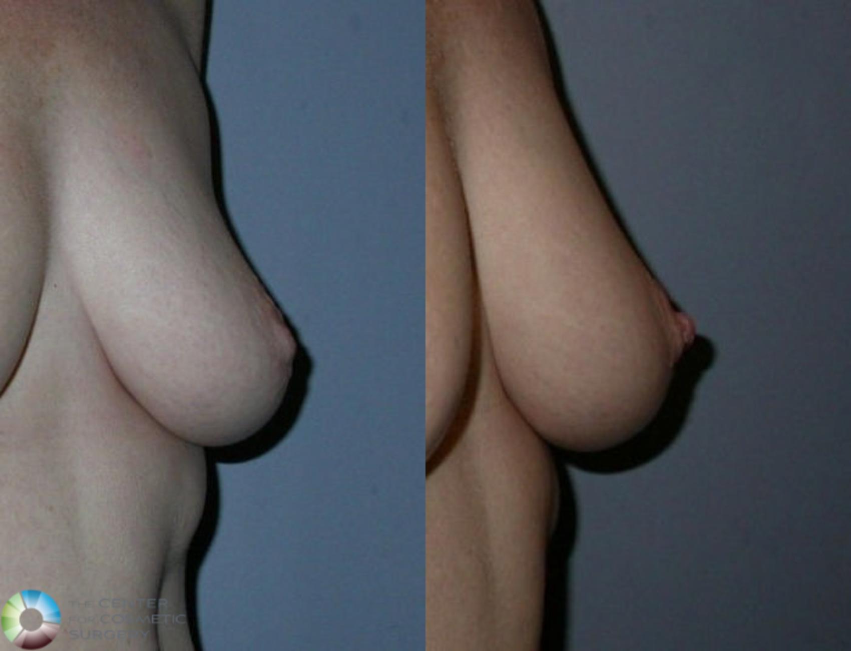 Before & After Inverted Nipple Repair Case 58 View #3 in Denver and Colorado Springs, CO