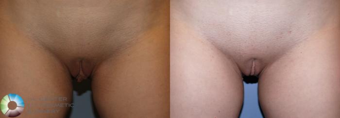 Before & After Labiaplasty Case 11223 Front View in Golden, CO