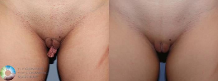 Before & After Labiaplasty Case 11663 Front View in Golden, CO