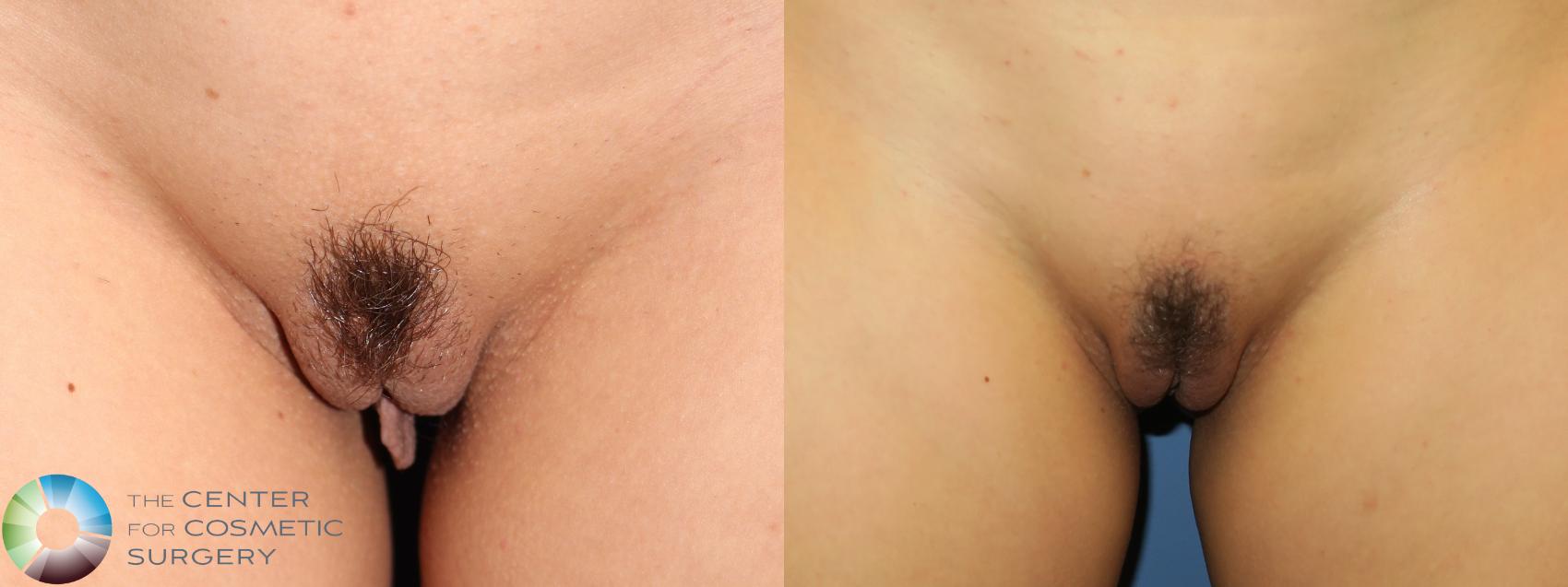Before & After Labiaplasty Case 11664 Front View in Golden, CO