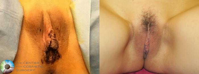 Before & After Labiaplasty Case 11664 Intra/Post-Op View in Golden, CO