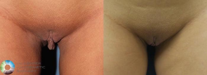 Before & After Labiaplasty Case 11685 Front View in Golden, CO