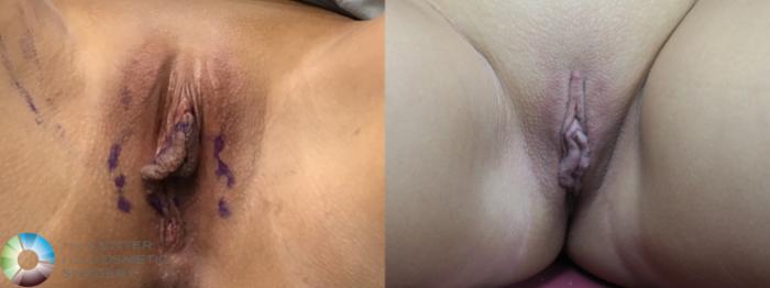 Before & After Labiaplasty Case 11685 Lithotomy in Denver, CO