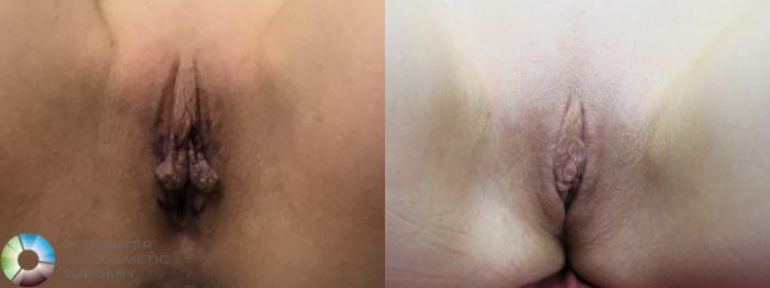 Before & After Labiaplasty Case 11686 Lithotomy in Denver, CO