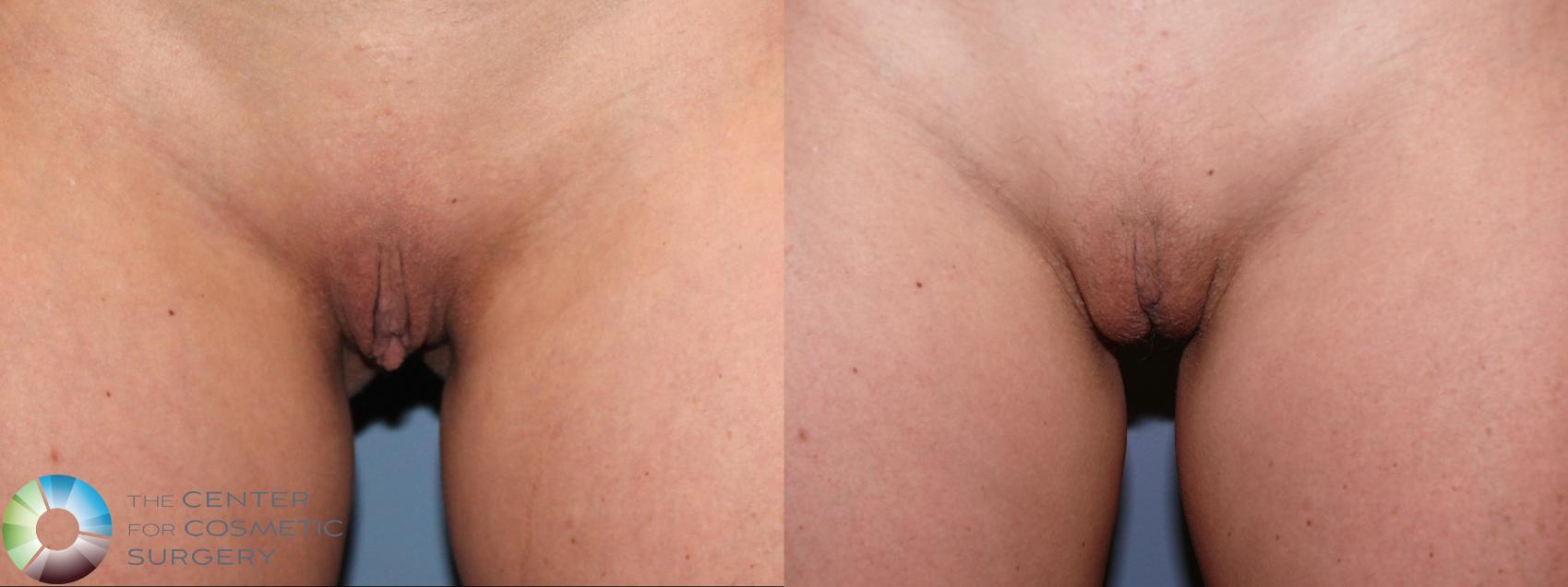 Before & After Labiaplasty Case 11944 Front in Denver and Colorado Springs, CO