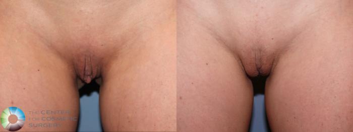 Before & After Labiaplasty Case 11944 Front View in Golden, CO